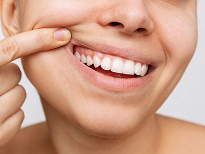 Gum Recontouring in Solomons MD